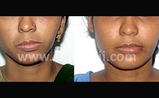 Stages of Distraction Osteogenesis 5 After Distractor Device Is Removed, Successful Completion Of Distraction To Treat Face Asymmetry