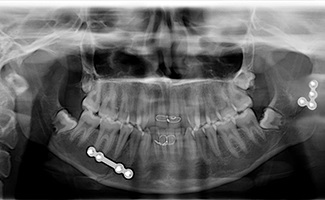 Multiple Fractures 7 After Surgery, X-Ray Showing Fixation Of Fracture Fragments