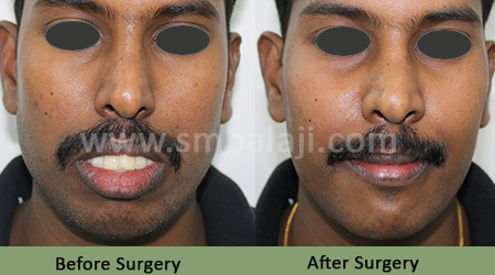 Upper Jaw Protrusion 5 Upper Jaw Protrusion - Before After Picture