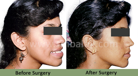 Upper Jaw Protrusion 4 Upper Jaw Protrusion - Before After Picture