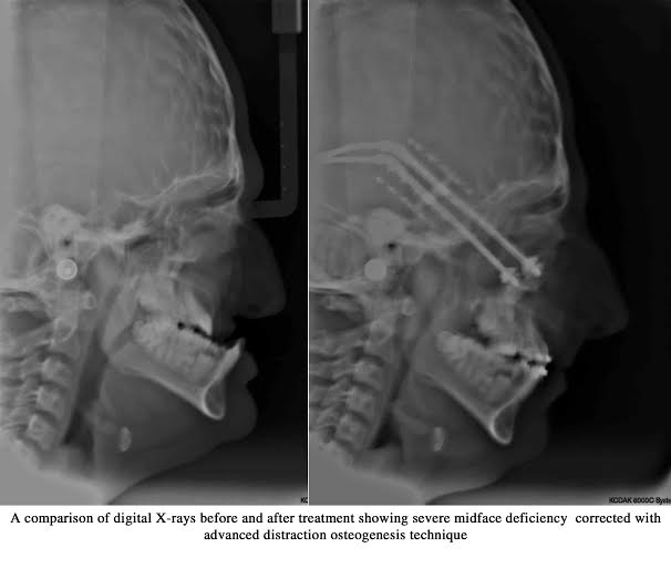 Crouzon Syndrome Before After Image