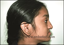 Deficient Or Retruded Upper Jaw (Maxilla)