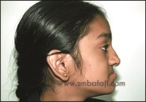 Upper Jaw Retrusion 3 Deficient Or Retruded Upper Jaw (Maxilla)
