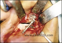 Upper Jaw Retrusion 6 Distractor Device Is Fixed To The Cut Bone Segments