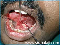 During Removal Of The Sialolith