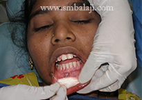 Immediately After Gum Treatment Using Laser In The Lower Jaw