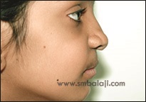 Upper Jaw Retrusion 10 Improved Profile Following Distraction