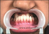 Upper Jaw Retrusion 4 Incorrect Occlusion (Bite)