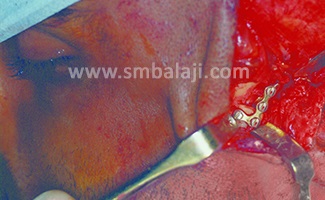 Jaw Joint (Tmj) Fracture Fixed With L Plate