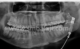 Stages of Distraction Osteogenesis 2 Latency Period- Before Activation Of Distractor