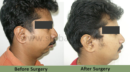 Lower Jaw Retrusion 2 Lower Jaw Retrusion