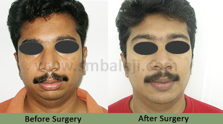 Lower Jaw Retrusion 1 Lower Jaw Retrusion