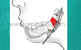 Types of Distraction Osteogenesis 8 Mandibular External Pin Retained Multivector Distractor