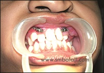 Upper Jaw Retrusion 8 Maxillary Advancement By Distraction Osteogenesis