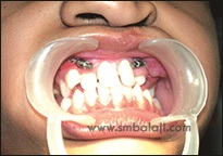 Maxillary Advancement By Distraction Osteogenesis