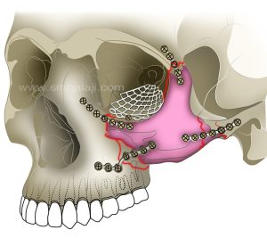 Multiple Fractures 1 Facial Trauma Care In India
