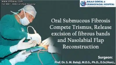Oral Submucous Fibrosis Compete Trismus, Release Excision Of Fibrous Bands And Nasolabial Flap Reconstruction