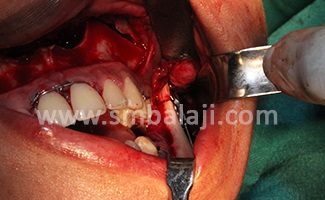 Stages of Distraction Osteogenesis 1 Osteotomy- Bone Cut And Distractor Device