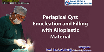 Periapical cyst Enucleation and Filling with Alloplastic Material