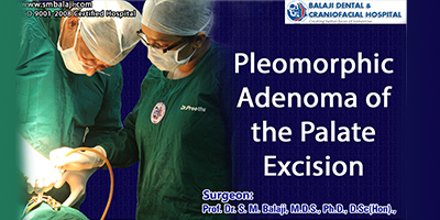 Pleomorphic Adenoma of the Palate Excision