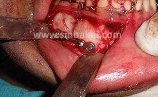 Right Side Lower Jaw Fracture Reduced And Fixed With Miniplate