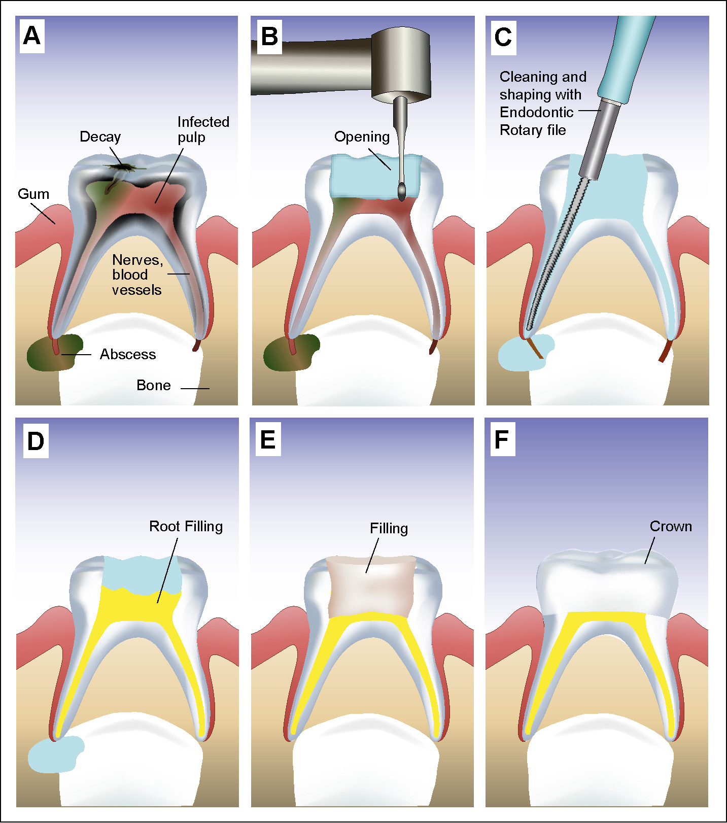 Root Canal Treatment For Child