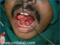 Salivary Gland Sialolith (Salivary Gland Stone)