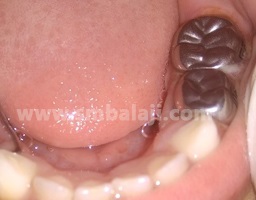 Stainless Steel Crowns 1 Stainless Steel Crowns