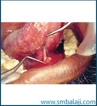 Submandibular Salivary Gland Calculus Present At The Entrance Of The Duct