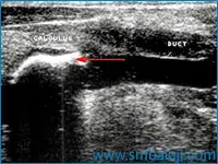 Ultrasound Showing The Presence Of Calculus In The Salivary Gland Ductd