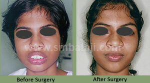 Upper Jaw Protrusion - Before After Picture