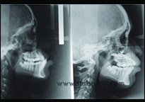 X-Ray Before Treatment Showing Retruded Upper Jaw, X-Ray After Distraction Showing Corrected Upper Jaw