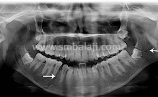 X-Ray Showing Multiple Fractures Of Lower Jaw And Jaw Joint (Tmj)