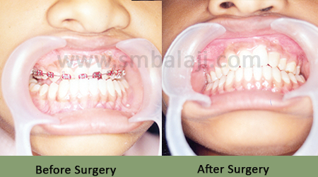 Before After - Upper Jaw Retrusion