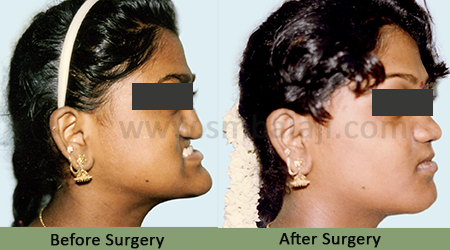Before After - Upper Jaw Retrusion