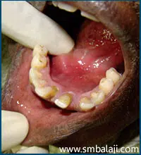 A Bulge On The Right Side Of The Floor Of The Mouth Indicating The Presence Of Submandibular Gland Calculus