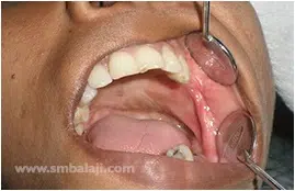 Complete Closure Of Defect And Good Healing Seen After Surgery