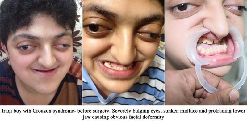 Crouzon Syndrome Treatment In India