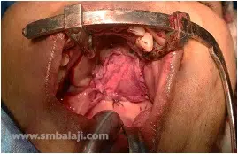 Flap Sutured Firmly In Place