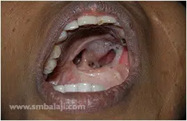 Palatal Fistula Following The Trauma