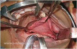 Temporalis Myofascial Flap Used To Close The Defect