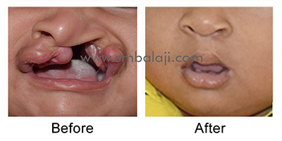 Primary cleft lip repair for a child with unilateral cleft lip and palate