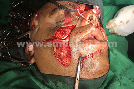 Dynamic Reanimation Surgery Performed By Dr S M Balaji Using The Temporalis Muscle And Fascia Lata Graft