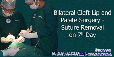 Bilateral cleft lip correction surgery suture removal