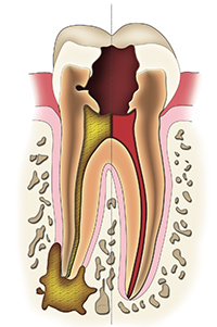 Extensive Tooth Decay Causing Severe Infection