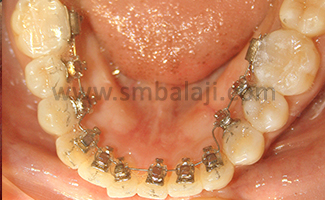 Lingual Braces For The Lower Teeth