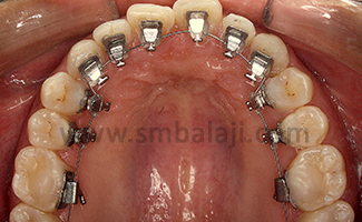 Lingual Braces For The Upper Teeth