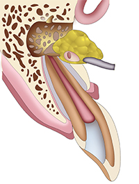 Schematic Illustration Of Apicoectomy Procedure