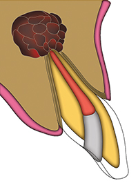 Restorative Dentistry 3 Severe Infection Near Root