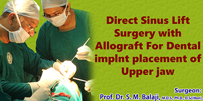 Sinus Lift procedure in chennai